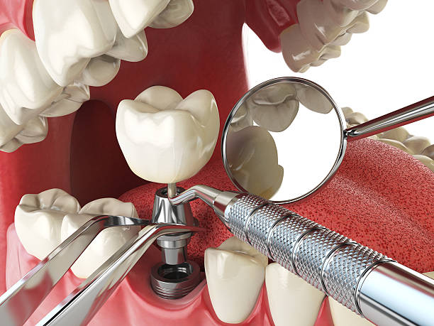Best Emergency Root Canal Treatment in Home Garden, CA